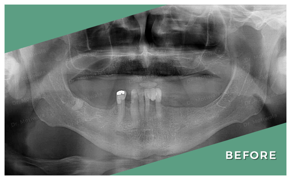 drmotiwaladcic's tweet image. Peace begins with a SMILE!

Full mouth dental implants with NexxZr Zirconia bridge 

#permanentteethin3days #immediateloadingimplants #singlepieceimplant #pterygoidimplant #basalimplants #singlevisit #nexxzrzirconiacrowns
#fullmouthdentalimplants #dentalimplants