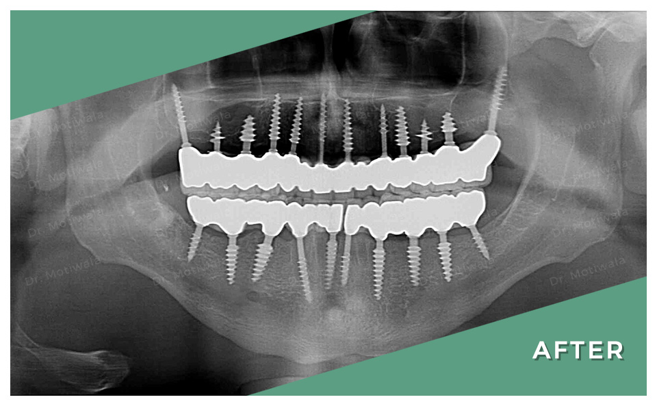 drmotiwaladcic's tweet image. Peace begins with a SMILE!

Full mouth dental implants with NexxZr Zirconia bridge 

#permanentteethin3days #immediateloadingimplants #singlepieceimplant #pterygoidimplant #basalimplants #singlevisit #nexxzrzirconiacrowns
#fullmouthdentalimplants #dentalimplants