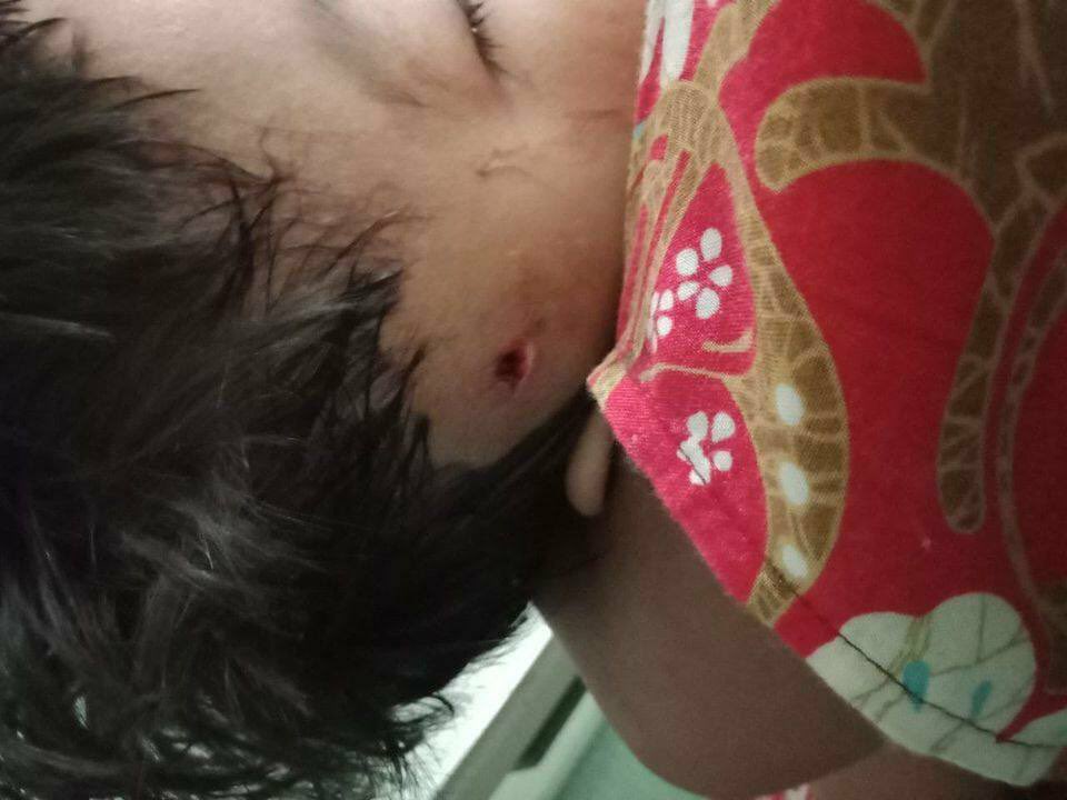 KSWin26's tweet photo. A 5 yo child from Kale who got head injury &amp; difficulty in walking by SAC terrorists’ heavy artillery munitions,has some difficulties for medical costs &amp; to get proper treatment in Mandalay. JUNTA USES COVID AS WEAPONS  #WhatsHappeningInMyanmar #July17Coup https://t.co/7enHhHzUKg