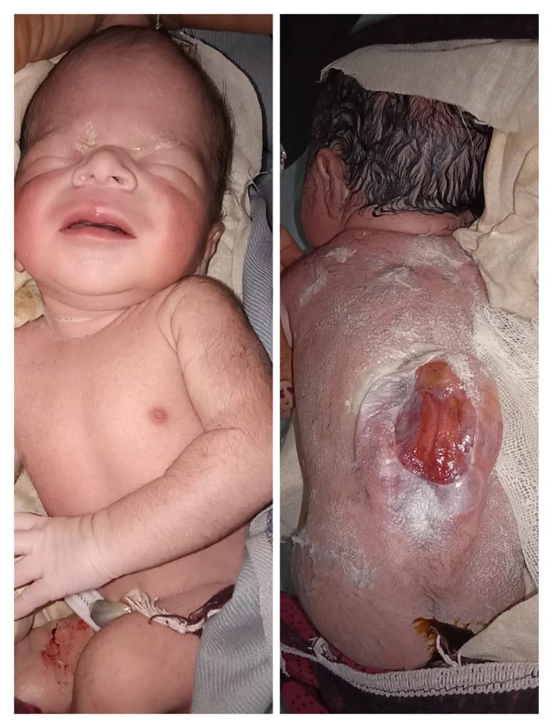RbskSh's tweet photo. Newborn with Neural tube defect Reffering to Civil Hospital Ahmedabad from Kandla Kutch @GandhidhamTho @CdhoKutch @PrantAnjar @KutchDdo @CollectorKutch @NHMGujarat @JpShivahare @PrabhavJoshi @GujHFWDept @GujaratSHRBSK @DrNilamPatel04 @pedspoojaparikh https://t.co/CWsX2X3YcK