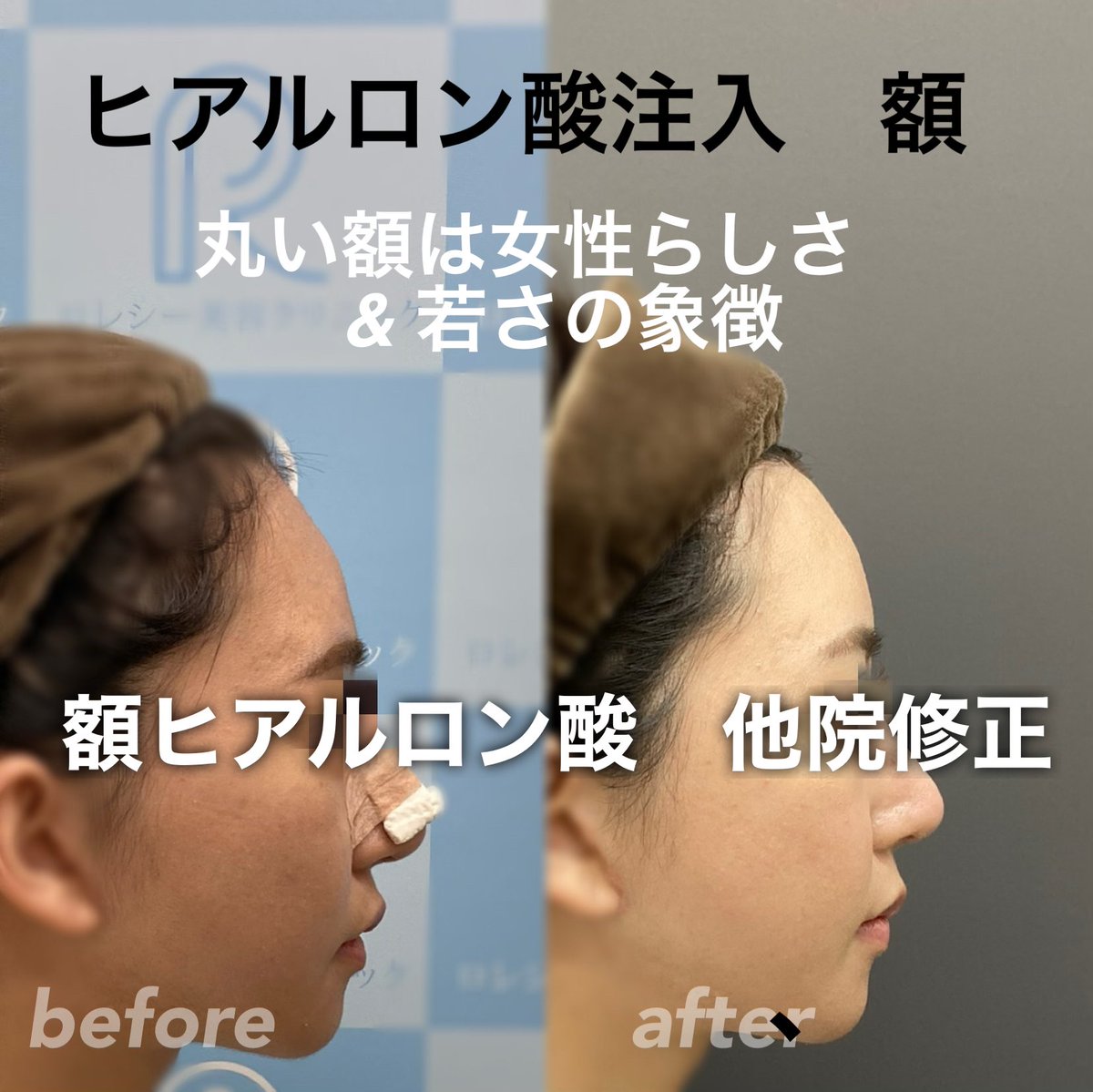 おでこヒアルロン酸