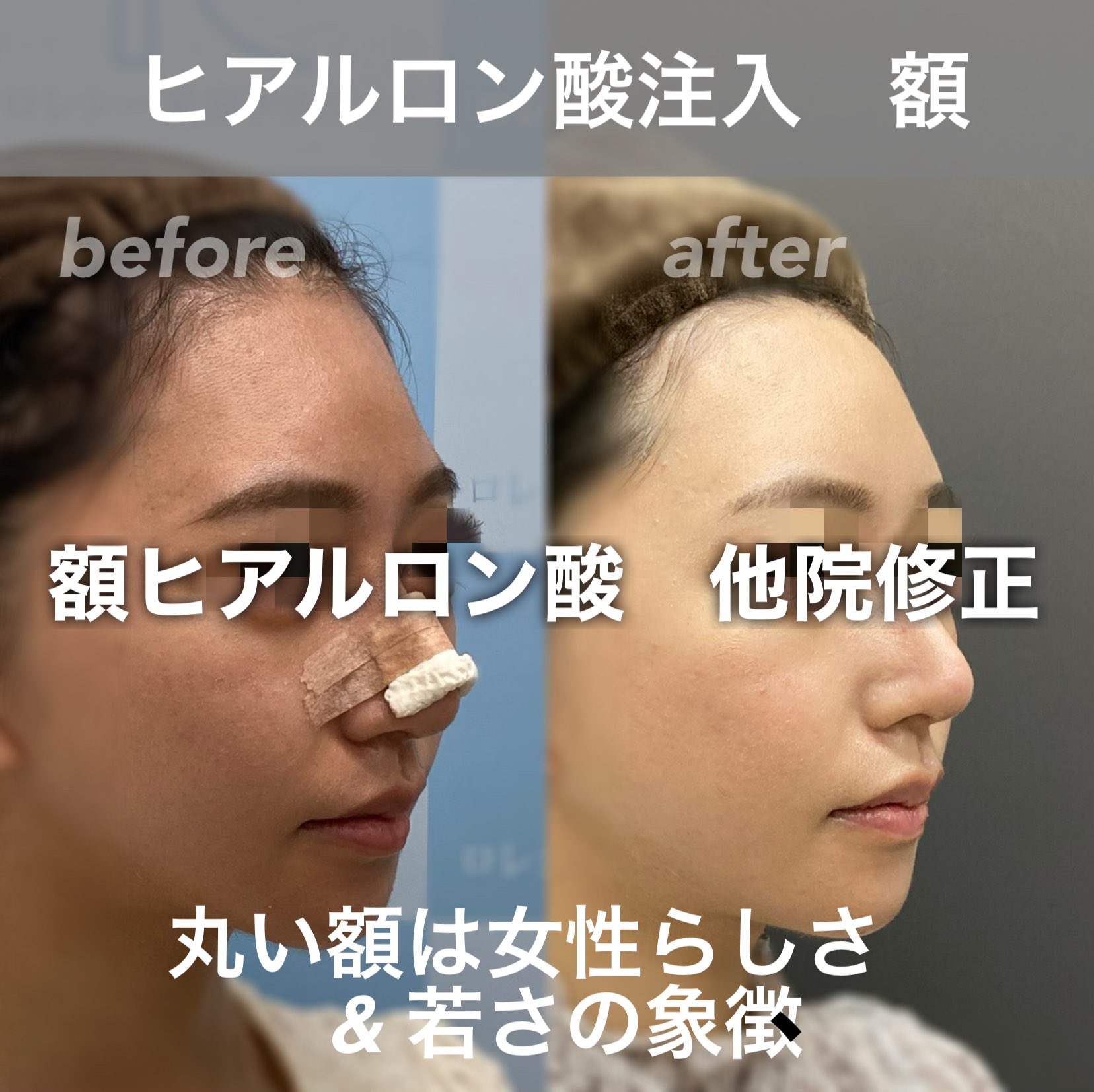ロレシー美容クリニック 心斎橋駅前院 額ヒアルロン酸 おでこヒアルロン酸 ヒアルロン酸注入 大変身 他院でボコボコになったヒアルロン酸を修正しました ボコをなおし 丸いおでこに大変身 モニター価格1cc 44 550円 T Co A5frajhcvr ロレシー美容クリニック 心斎橋駅前院 額ヒアルロン酸 おでこヒアルロン酸 ヒアルロン酸注入 大変身 他院でボコボコになったヒアルロン酸を修正しました ボコをなおし 丸いおでこに大変身 モニター価格1cc 44 550円 T Co A5frajhcvr