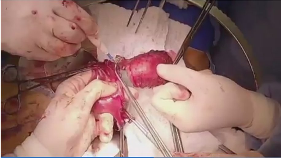 IJGConline's tweet photo. @glaucobaiocchi @br_gynoncgroup @OncoAlert The #video includes radical abdominal trachelectomy. The proximal incision was made on the uterine cervix sparing 1 cm of it, close to the uterine isthmus, a cervical cerclage was performed. #video #melanoma #trachelectomy @ESGO_society @ENYGO_official @IGCSociety @agz_eriksson https://t.co/FoBm7h9k1c
