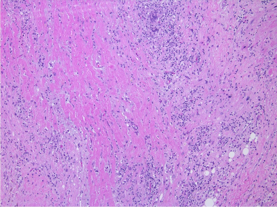 Akshay Desai (@akshaydesaimd) on Twitter photo This endomyocardial biopsy is diagnostic of which of the following entities? #HFSABoardReview2021 <a href="/nancysweitzer/">Nancy Sweitzer</a> <a href="/mrchrtfaildoc/">Maria Rosa Costanzo</a> <a href="/jonrichmd/">Jonathan Rich</a> <a href="/HFSA/">HFSA</a> This endomyocardial biopsy is diagnostic of which of the following entities? #HFSABoardReview2021 <a href="/nancysweitzer/">Nancy Sweitzer</a> <a href="/mrchrtfaildoc/">Maria Rosa Costanzo</a> <a href="/jonrichmd/">Jonathan Rich</a> <a href="/HFSA/">HFSA</a>