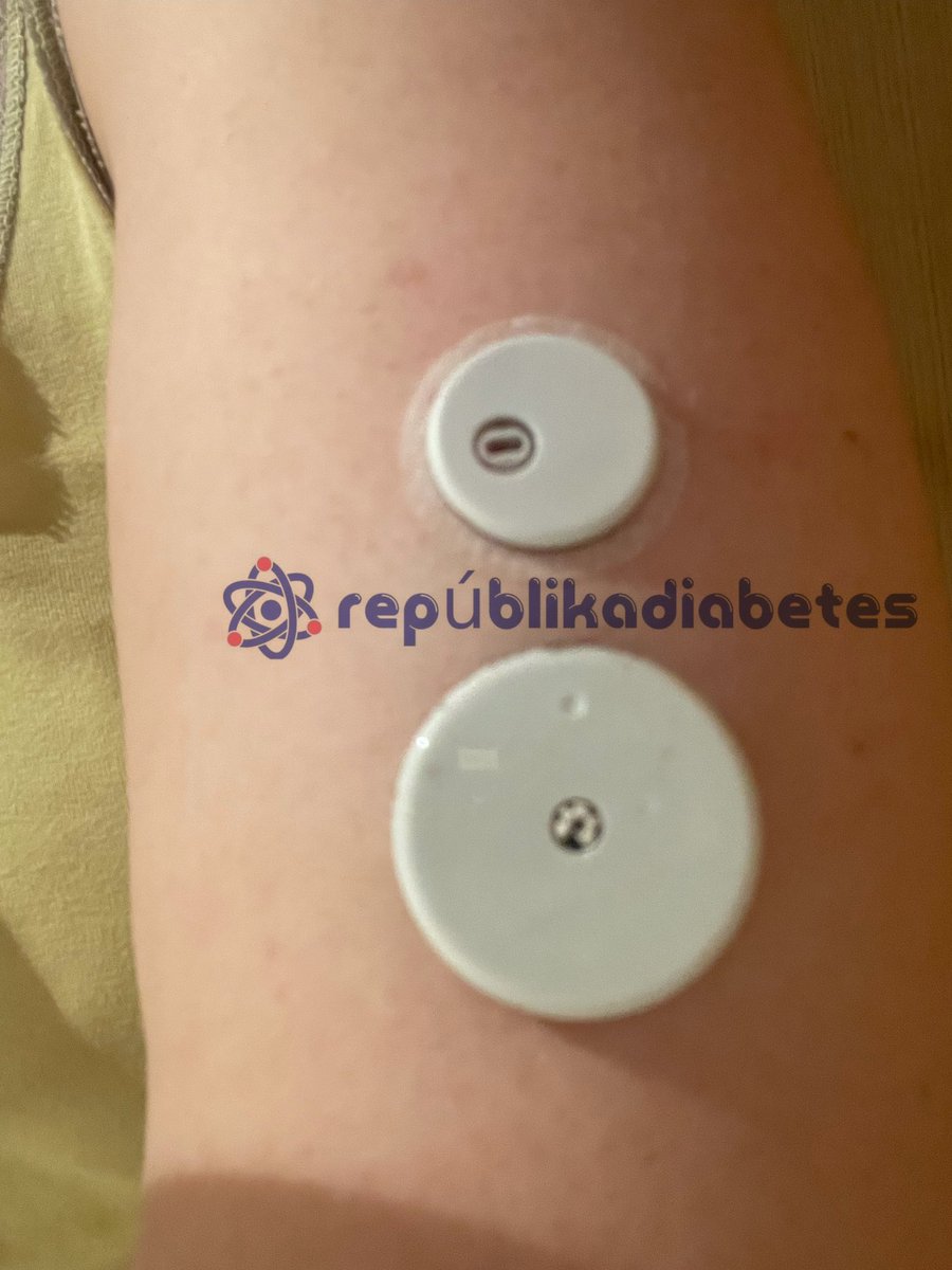 La diferencia de tamaño libre2 y 3 es muy notable! Inserción todavía más indolora y 60’ de calentamiento (sin cambio respecto al libre 2). Sigue siendo necesario NFC para iniciarlo y no hay opción al uso lector.#diabetESP #freestylelibre3