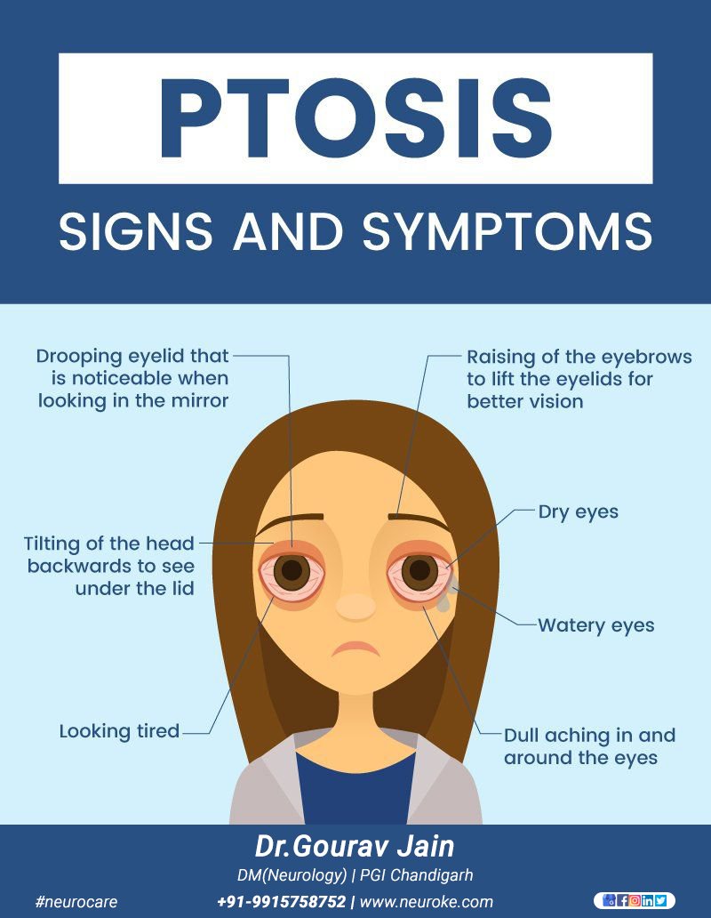 Neuroke1's tweet image. #PTOSIS

O #Drooping #eyelid that is noticeable when looking in the mirror
O Raising of the #eyebrows to lift the eyelid for better #vision
O Tilting of the #head backwards to see under the #lid
O #Dull #aching in and aroud the eyes
O Looking #tired
O #Watery Eyes
O Dry Eyes
