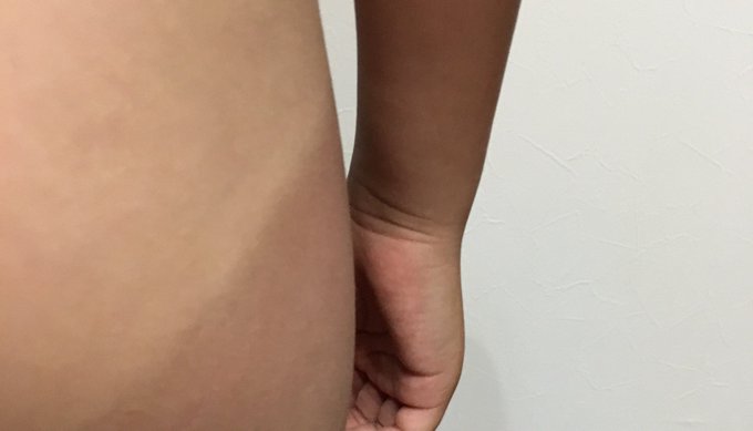 息子、午前と午後で5時間くらいプール入っていた結果…日焼けすごっ‼️ 