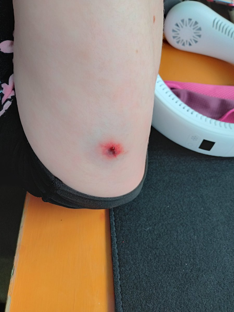 tactical_kaki's tweet photo. 今後、初速爆上げで勝ったろーって奴が出てこないようにする為にツイートします。
フィールド名は伏せますがサバゲー定例会にて画像1の電動で30mくらいから撃たれました。(射手とは知り合いではないです)
スポーツインナーの上に被弾しましたが血がでました(画像2)
撃たれた数時間後(画像3)

続く https://t.co/WfAUPZt8H2