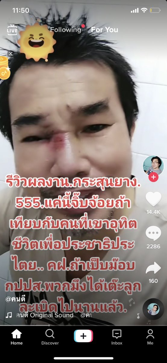 Donaldae's tweet image. โอโห ดูรอยกระสุนยางบนหน้าพี่เค้า อีกนิดตาบอดแล้วอ่ะ อีชิบหาย 🤬