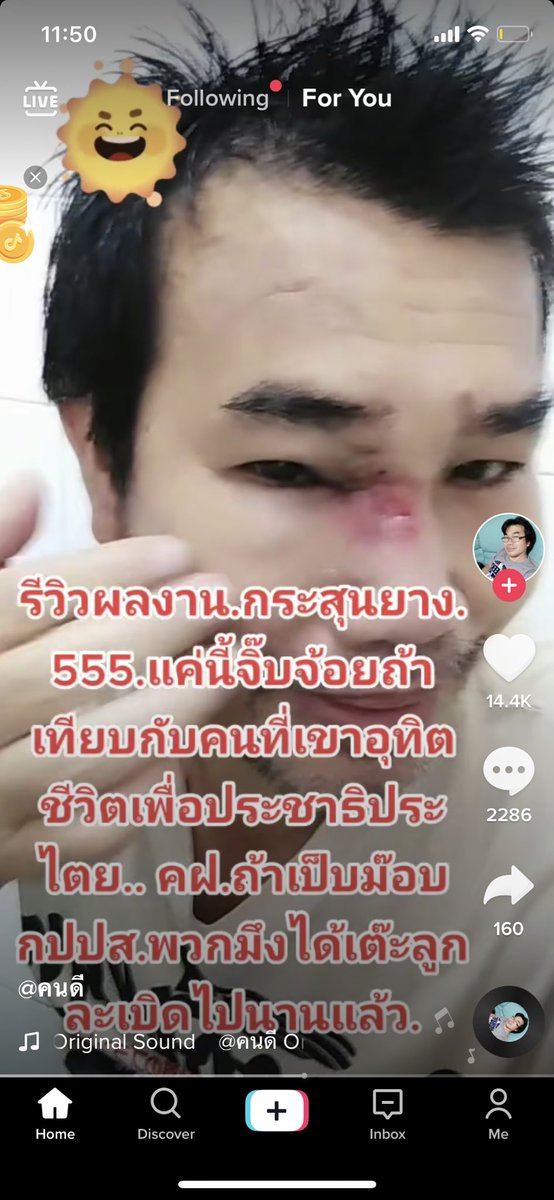 Donaldae's tweet image. โอโห ดูรอยกระสุนยางบนหน้าพี่เค้า อีกนิดตาบอดแล้วอ่ะ อีชิบหาย 🤬