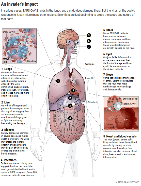 Cleavon_MD's tweet photo. As a reminder, COVID kills in many ways:
Heart ➡️myocarditis
Lungs ➡️pneumonia
Brain➡️ seizures
GI ➡️ diarrhea ➡️ renal failure

It forms blood CLOTS in
Lungs➡️pulmonary embolism
Heart➡️heart attack
Brain➡️stroke
Kidney➡️ renal failure➡️dialysis
Leg artery➡️amputation https://t.co/tq4xcppxou
