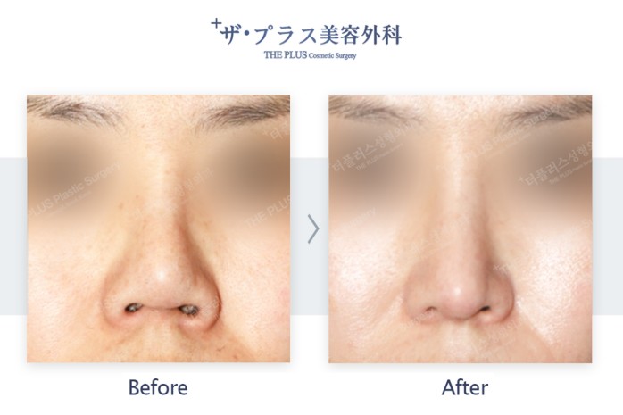 鼻形成術 Aesthetic Rhinoplasty 美容外科手術手技 裁断済 | guardline.kz