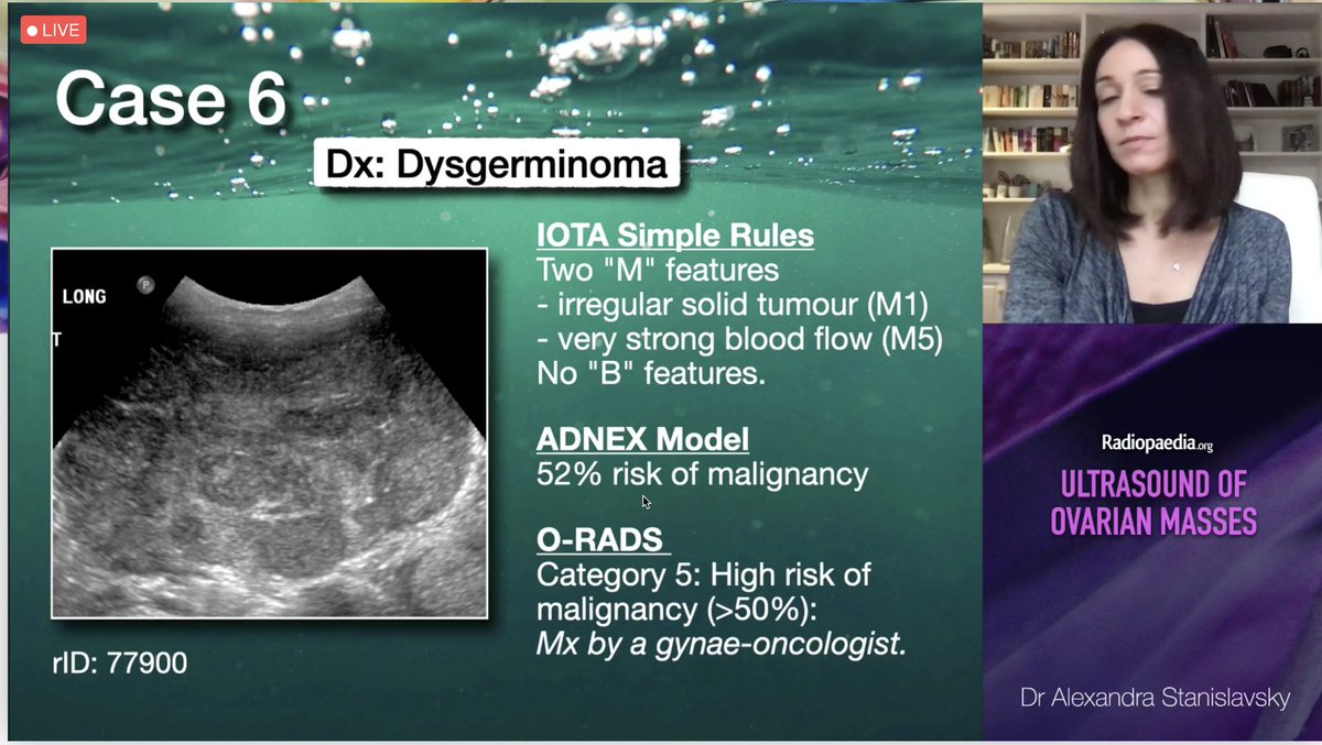 Absolutely loving the #Radiopaedia2021 LIVE stream - asking questions to <a href="/4lexandraS/">Alexandra Stanislavsky</a> and <a href="/EmmelineLee/">Emmeline Lee (she/her)</a> in real-time. 

Also, practice-changing talk already - I'm going to integrate ADNEX model and O-RADS into my reports as well as IOTA simple rules.

#radiology #radres #ultrasound