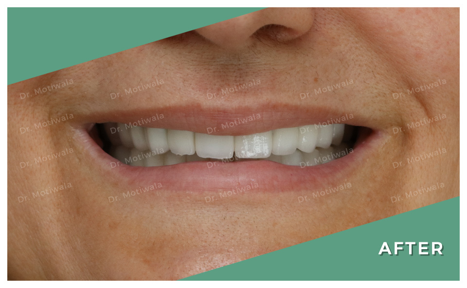 drmotiwaladcic's tweet image. A smile is the prettiest thing you'll ever wear!  

Our patient had a full mouth dental implants with NexxZr zirconia bridge 

#permanentteethin3days #immediateloadingimplants #singlepieceimplant #pterygoidimplant #basalimplants #singlevisit #nexxzrzirconiacrowns