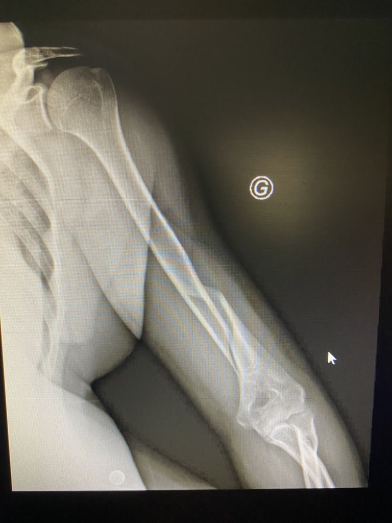 𝕷𝖚𝖈𝖆𝖘 on Twitter "C’est une frature de l’humerus spiroïde, surnommé la