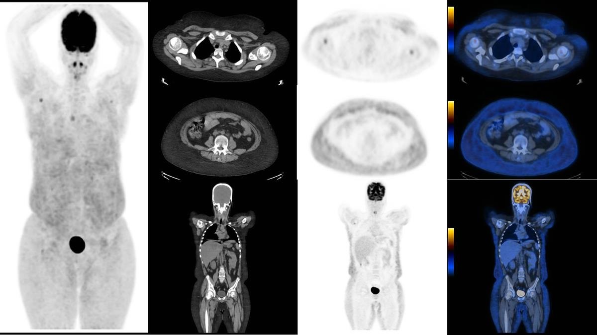 Current Issue: Diffuse Subcutaneous Metabolic Activity in Post Bone Marrow Transplant Hodgkin Lymphoma dlvr.it/S414Lb