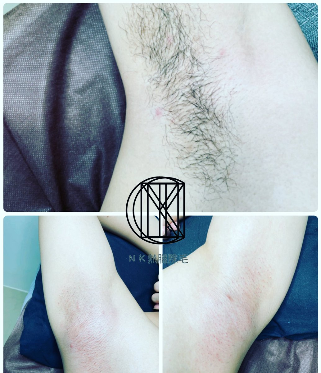 NK男士熱臘除毛
除毛師NICK
⭐️完全預約
📱諮詢預約Line:lin.ee/7R6AyiL

#男士熱臘除毛#熱臘除毛#巴西式除毛＃無毛＃除毛＃男性除毛