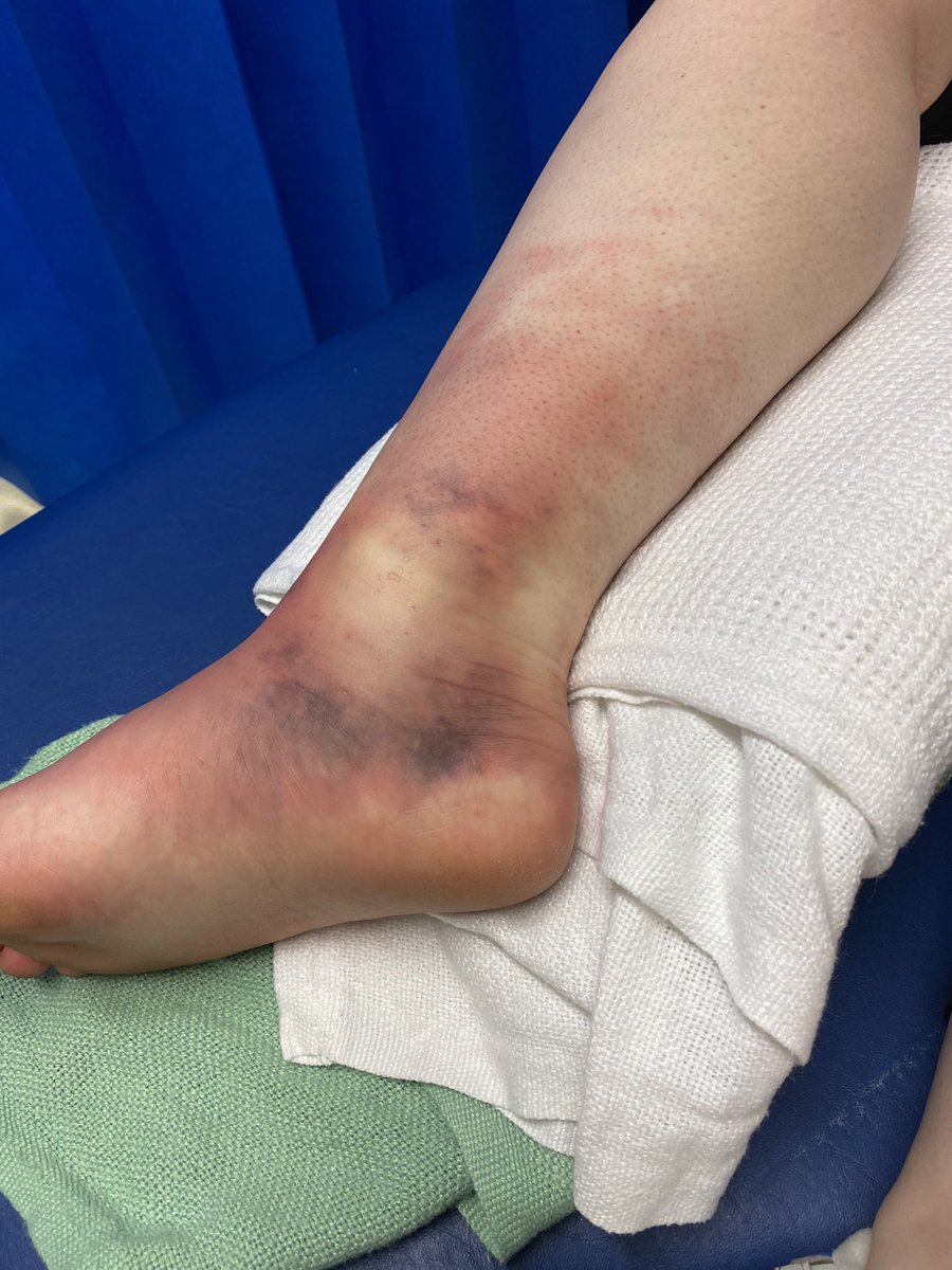 Stephwhit81's tweet photo. @Dominos_UK Fell over causing dislocated ankle and 5 breaks 💀 finally being released from hospital today so this would really cheer me up 🥺🍕🙂 #FreeDOMINOESday #pizzaisthemedicineineed https://t.co/zCFapJrKaj