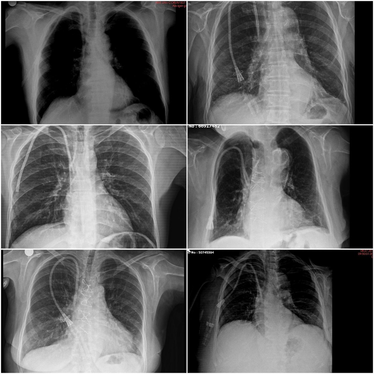 In a patient referred for Transoesophageal echocardiography with a prediagnosis of catheter thrombosis and/or endocarditis, I first look at the x-ray graph.  If the X-ray is like one of these, the probability of seeing a positive finding in TEE is very low.  What do you think.