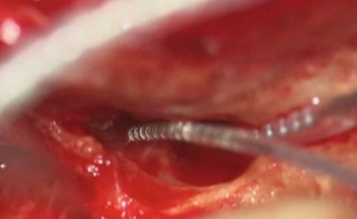 BionicVest's tweet image. Done! First cochleo-vestibular implanted patient in #Italy. The surgery was a complete success. In a month will be the activation. 

Now all clinical centers involved in the first multi-centric study of otolith-vestibular implant has at least one patient.

#GreatMonday