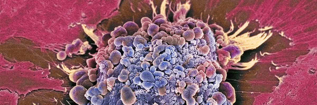 The innate #immune system relies on a two-step process directed by two intracellular protein families to prime, then kill melanoma #cancer cells. A new study in mouse and human cells by <a href="/LM_Koenig/">Lars M. Koenig</a> and <a href="/LMU_Muenchen/">Universität München</a>, @LMU_Uniklinikum scientists: fcld.ly/o7gv9n3