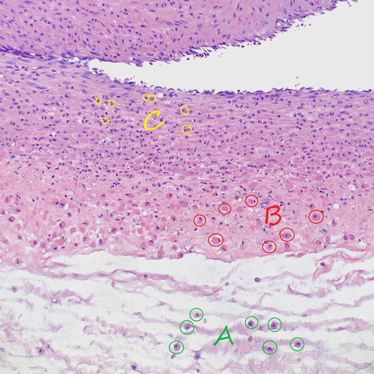 This is a section of umbilical cord showing one of the umbilical arteries. Who knows what's going on? What cells are represented by A, B, and C? Classic example. #pedipath #placentapath #placentabuddies