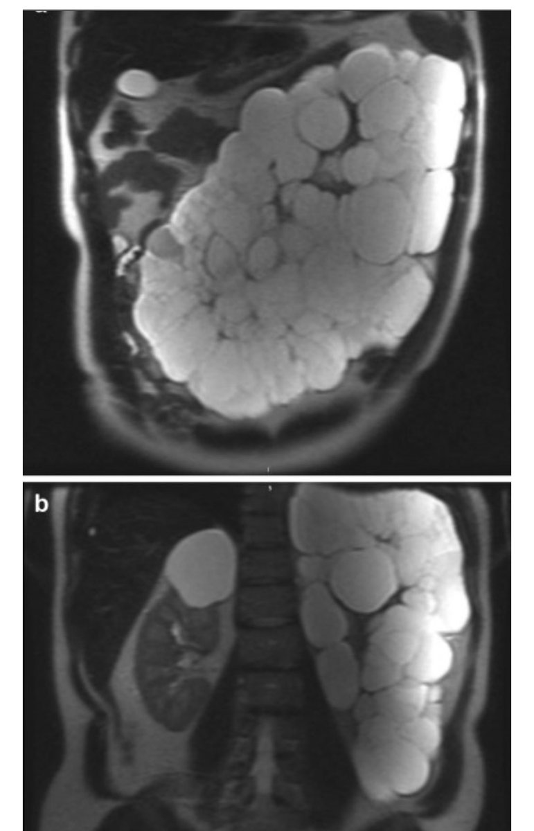 Carissa Dumancas (@md_cyd) on Twitter photo Check out this cool case of unilateral polycystic kidney disease published in Kidney International! authors.elsevier.com/a/1dQ-xJOcpjsxd <a href="/MayoClinicNeph/">Mayo Clinic Nephrology</a> <a href="/fouadchebib/">Fouad Chebib, MD, FASN</a> #ADPKD Check out this cool case of unilateral polycystic kidney disease published in Kidney International! authors.elsevier.com/a/1dQ-xJOcpjsxd <a href="/MayoClinicNeph/">Mayo Clinic Nephrology</a> <a href="/fouadchebib/">Fouad Chebib, MD, FASN</a> #ADPKD