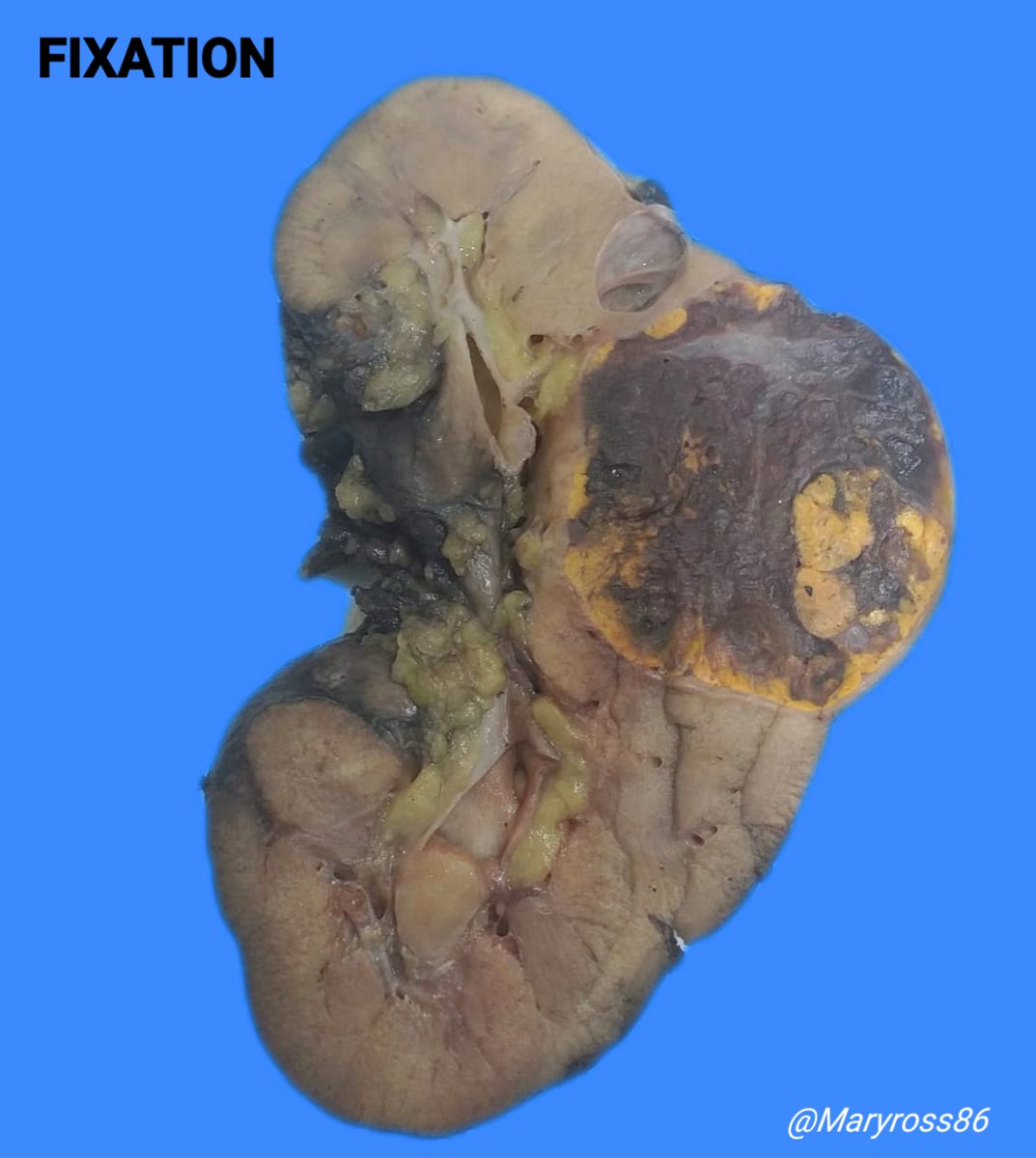 Kidney tumour. #Grosspath #pathResident #pathology #GUpath #uropath #oncopath