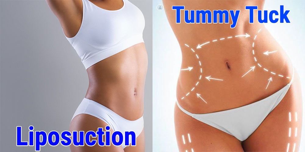 HealthSmith1's tweet photo. 😌 Two surgical methods to remove fat from the abdomen 😱
#liposuction #tummytuck #mommymakeover #abdomen #body #removefat #loseweight #fitness 
▶️ https://t.co/kpZJBycw4z ◀️ https://t.co/wT655wGUO2