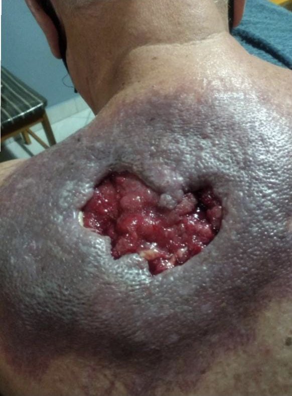 letsthais's tweet photo. THREAD – AJUDE O MEU PAI A RECUPERAR A PELE 

Meu pai desde o final de março enfrenta um abscesso na região do dorso esquerdo devido Diabetes descompensada. 
Ele é um pai maravilhoso, resolvi abrir essa vakinha para ele não ter que parar o tratamento ➡️ https://t.co/lrfUPlteTJ https://t.co/GhHuG9wS0n