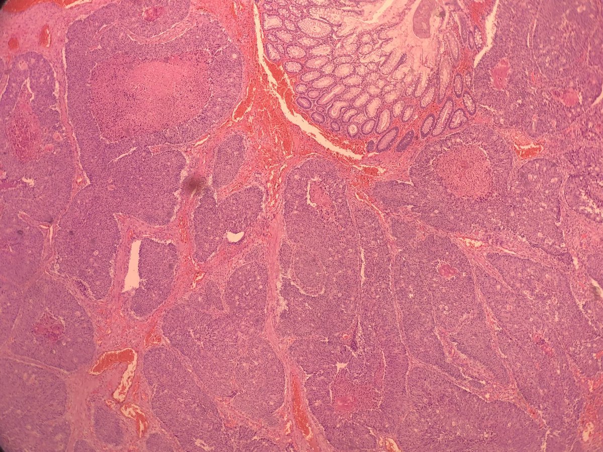 RafaPinheiro_'s tweet photo. I just love a colorectal cribriform comedo type adenocarcinoma. Too bad this is no longer a WHO diagnosis. Who else misses it? #PathTwitter #GIPath #gastrointestinalpathology #colorectalcancer #colorectalpathology #Pathaward https://t.co/cqTQYVyQQk