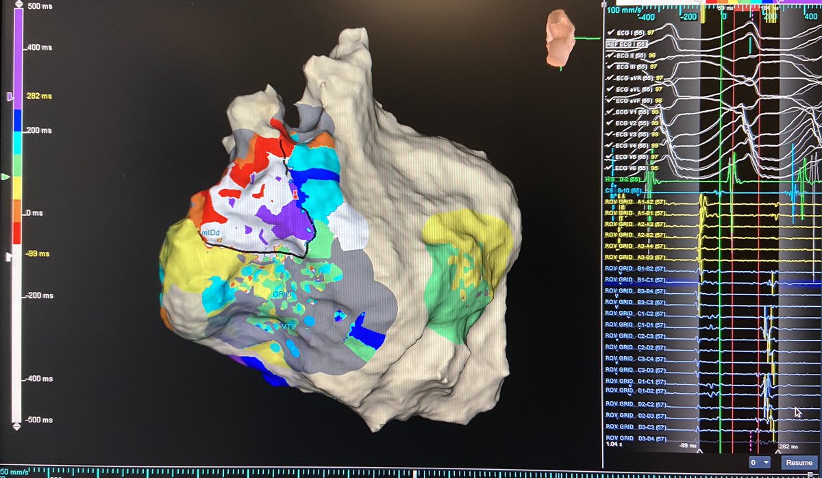 texasEPkait's tweet photo. Interesting circuit in this ischemic VT patient who had 3 prior ablations at another facility. Turning our low V ID down to 0.15mV helped uncover the rest of this circuit. Mapped by @PraveenRao_EP with the #hdgrid by @AbbottCardio #ablatevt #epeeps #ischemicvt https://t.co/MCRxUgBzVB