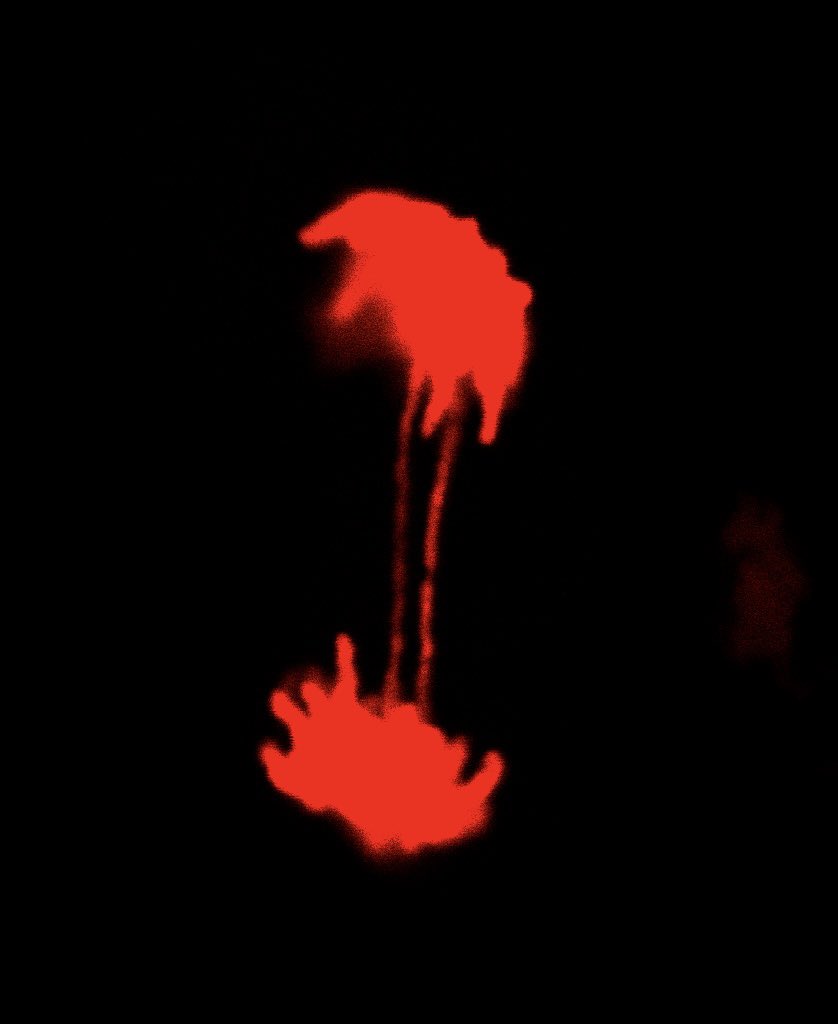 F_Gianfrancesco's tweet image. A fantastic view of a cell with chromosomal instability: two bridges are better than one #mitosis #anaphase #chromosomalbridges