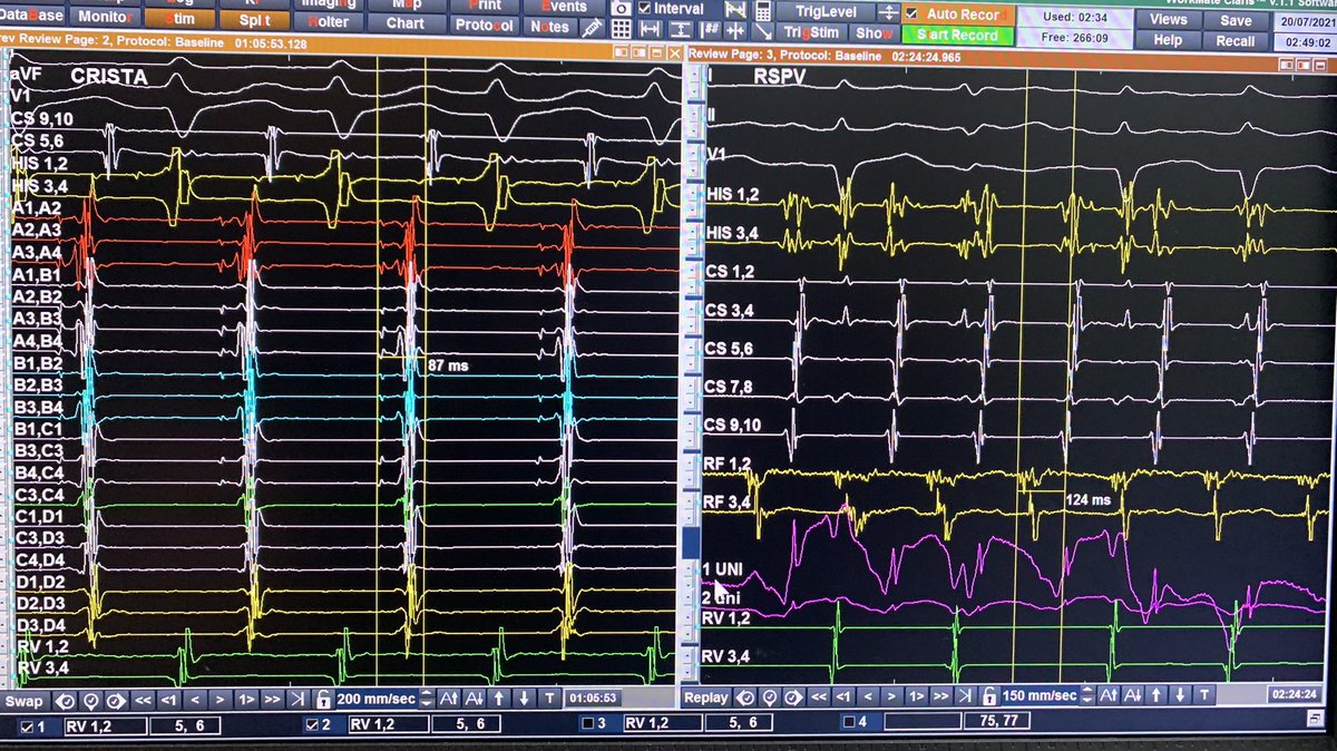 Dr Ulhas Pandurangi (@ulhasdr) on Twitter photo CRISTA-RSPV proximity
Ablated inside RSPV- just a touch! No isolation
@ecgoxford <a href="/SchakrabartiEP/">Shanta Chakrabarti</a> <a href="/syamkumarmd/">Syamkumar</a> <a href="/narrowQRS/">JMC</a> <a href="/abhishek_mbbs/">Abhishek</a> <a href="/Hapa_EP/">Kevin Brady</a> <a href="/PaymardM/">Mohammad Paymard MD FRACP FHRS FACC</a> <a href="/javadm20/">javad mikaeili</a> <a href="/jeffrey_vinocur/">Jeffrey M Vinocur</a> <a href="/KartikeyaEPrunn/">Kartikeya Bhargava</a> <a href="/KakkamKrishna/">Krishna Kumar</a> <a href="/SuchitMajumder/">Suchit Majumdar</a> <a href="/drnjy/">Niraj Yadav</a> <a href="/EPeeps_Bot/">EP_Bot</a> #EPeeps <a href="/sabarisarav/">sabari saravanan</a> CRISTA-RSPV proximity
Ablated inside RSPV- just a touch! No isolation
@ecgoxford <a href="/SchakrabartiEP/">Shanta Chakrabarti</a> <a href="/syamkumarmd/">Syamkumar</a> <a href="/narrowQRS/">JMC</a> <a href="/abhishek_mbbs/">Abhishek</a> <a href="/Hapa_EP/">Kevin Brady</a> <a href="/PaymardM/">Mohammad Paymard MD FRACP FHRS FACC</a> <a href="/javadm20/">javad mikaeili</a> <a href="/jeffrey_vinocur/">Jeffrey M Vinocur</a> <a href="/KartikeyaEPrunn/">Kartikeya Bhargava</a> <a href="/KakkamKrishna/">Krishna Kumar</a> <a href="/SuchitMajumder/">Suchit Majumdar</a> <a href="/drnjy/">Niraj Yadav</a> <a href="/EPeeps_Bot/">EP_Bot</a> #EPeeps <a href="/sabarisarav/">sabari saravanan</a>
