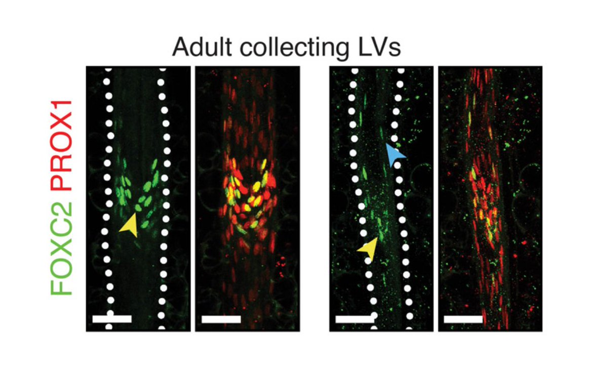 Endothelial Cell News (@endothelialnews) on Twitter photo Researchers report that inactivation of the mechanosensitive transcription factor Foxc2 in adult lymphatic #endothelium leads to a stepwise intestine-to-lung systemic failure.
Open access in <a href="/ScienceAdvances/">Science Advances</a>:
bit.ly/3eC0IR9 Researchers report that inactivation of the mechanosensitive transcription factor Foxc2 in adult lymphatic #endothelium leads to a stepwise intestine-to-lung systemic failure.
Open access in <a href="/ScienceAdvances/">Science Advances</a>:
bit.ly/3eC0IR9