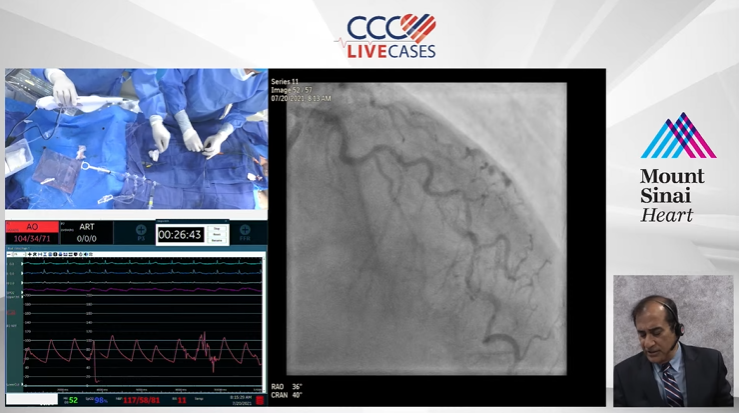 ccclivecases's tweet photo. We're LIVE now! Ask us your questions.
‘RotaTripsy’ of Tortuous Calcified LAD/D1 Bifurcation
https://t.co/lLZG6WvdPN
#cardiotwitter #cardiology #interventionalcardiology #ccclivecases #minicrush #IVL https://t.co/SbMB8w4KTM