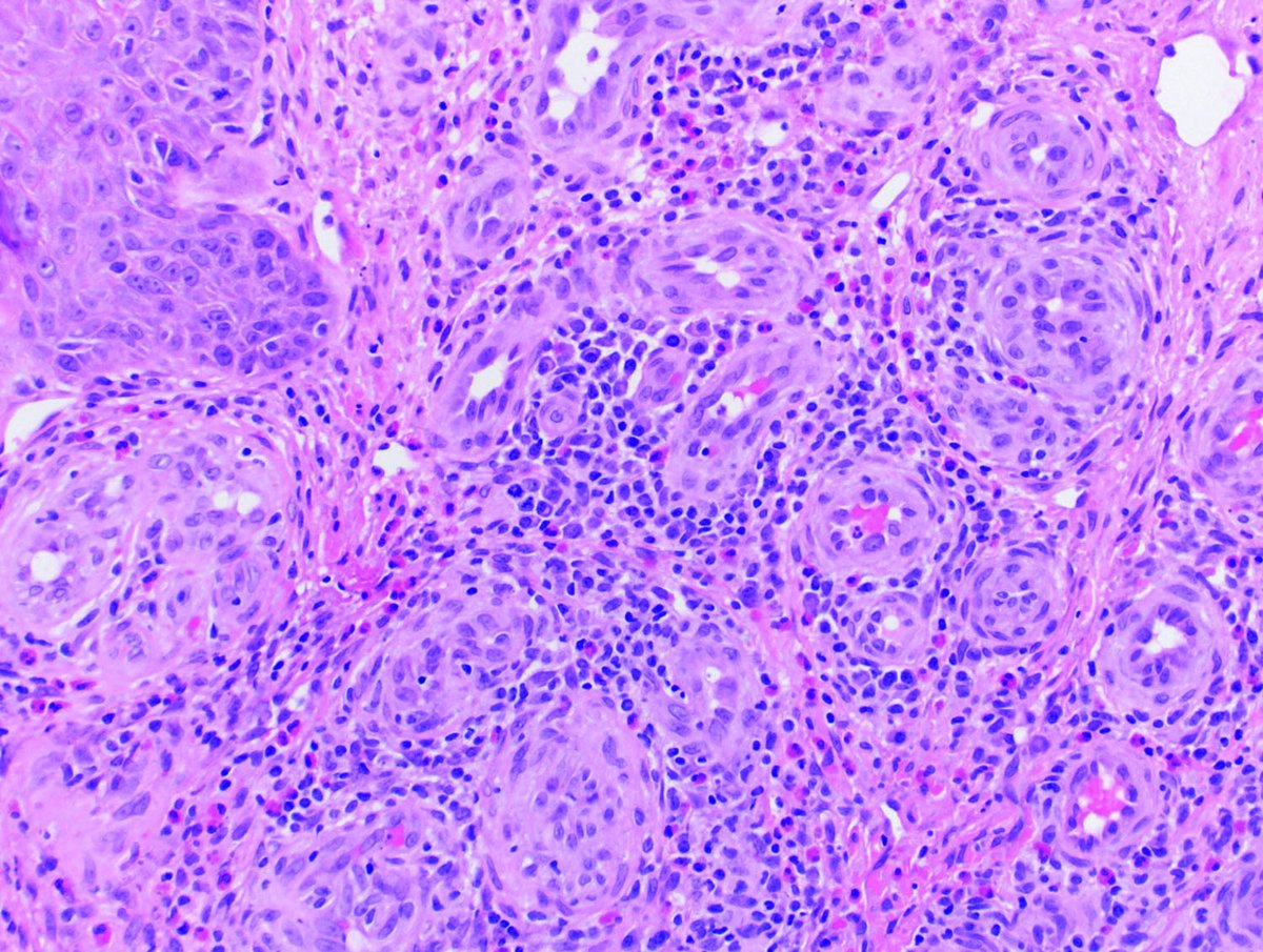 JCADermatology's tweet image. In our #EmergingAuthors column, Brahs et al describes a Filipino male patient with skin lesions on his lips and nose. Discrete papules, lack of lymphadenopathy, and histological findings were consistent with angiolymphoid hyperplasia with eosinophilia. bit.ly/3zfAr2R