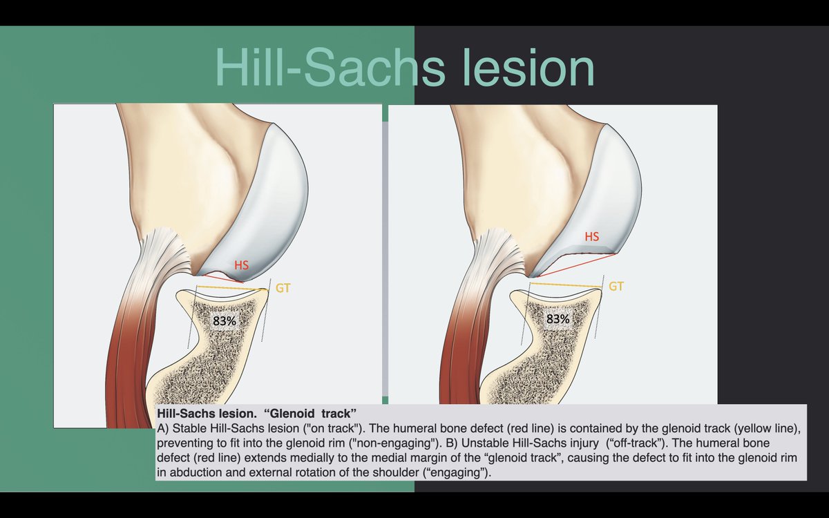 DmcRadiologia's tweet photo. A challenge is to define the extent of glenoid bone loss (GBL) above which glenoid reconstruction is required (critical defect >25%; subcritical 15-20%, and minor defect <15%), the glenoid track of a Hill-Sachs defect, and de modified glenoid track in case of bipolar bone loss. https://t.co/fjZoDoVZhJ