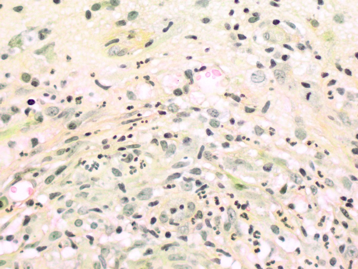 NeuroEyepath's tweet image. In an HIV aids patient with chronic #Cryptococcus infection, brain biopsy shows non-necrotizing granulomas in the cortex and leptomeninges, as well as scattered organisms positive for PAS and mucicarmine. #neuropath