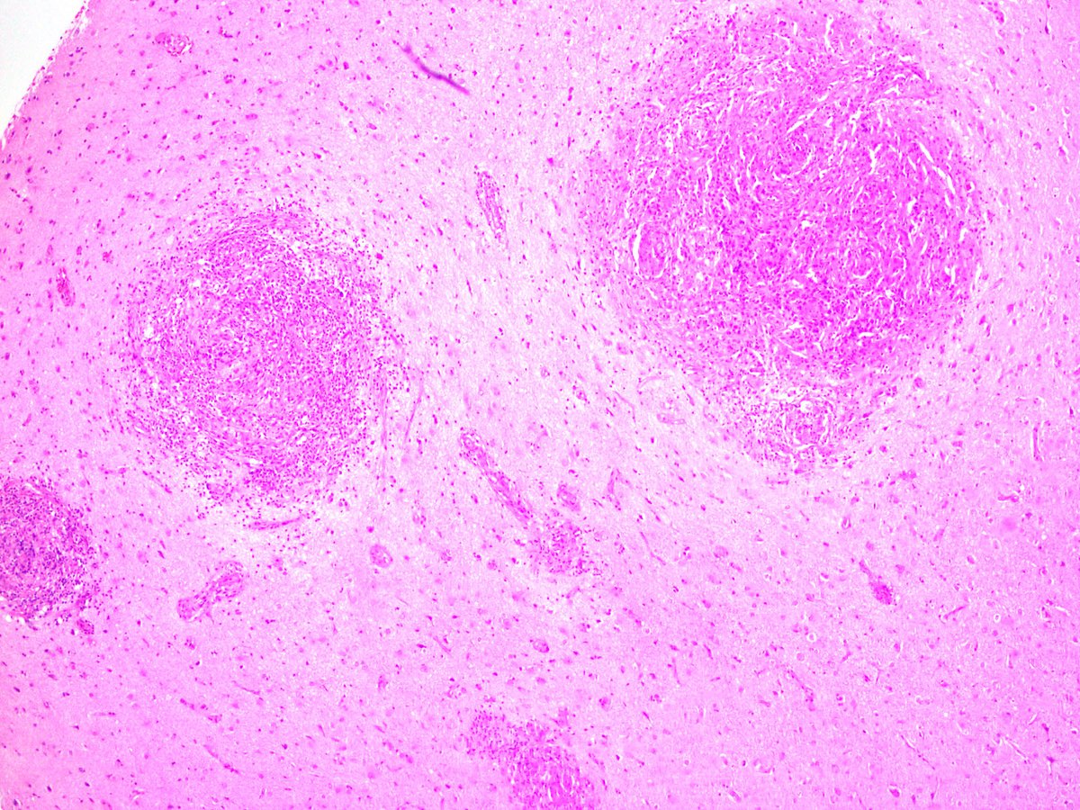 NeuroEyepath's tweet image. In an HIV aids patient with chronic #Cryptococcus infection, brain biopsy shows non-necrotizing granulomas in the cortex and leptomeninges, as well as scattered organisms positive for PAS and mucicarmine. #neuropath