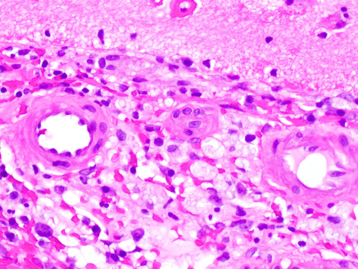 NeuroEyepath's tweet image. In an HIV aids patient with chronic #Cryptococcus infection, brain biopsy shows non-necrotizing granulomas in the cortex and leptomeninges, as well as scattered organisms positive for PAS and mucicarmine. #neuropath