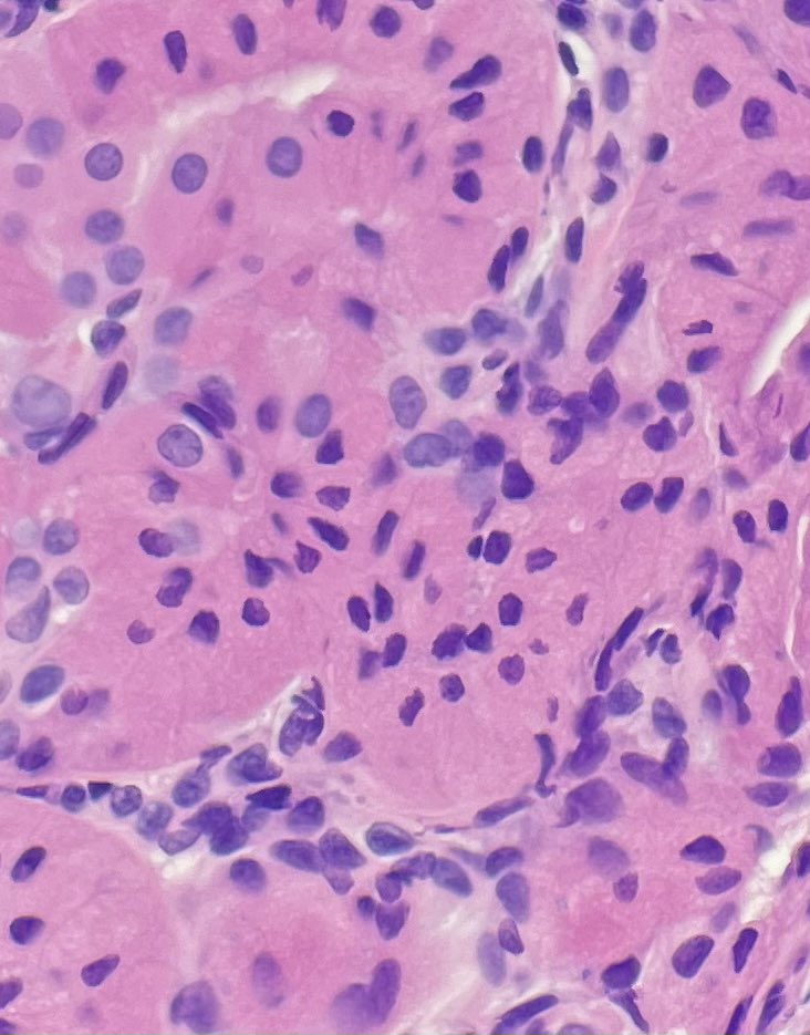 73 YOF conjunctival nodule (*classic presentation- elderly female*) there are some juicy mitochondria down there  <a href="/ingridtam/">Ingrid Tam</a> @thedermypathres <a href="/KaranKVats/">Karan Vats</a>  <a href="/josuelilly/">Josué Lilly</a> 👀 👀 #dermpath #dermtwitter #opthopath #ENTpath #PathTwitter #pathresidents