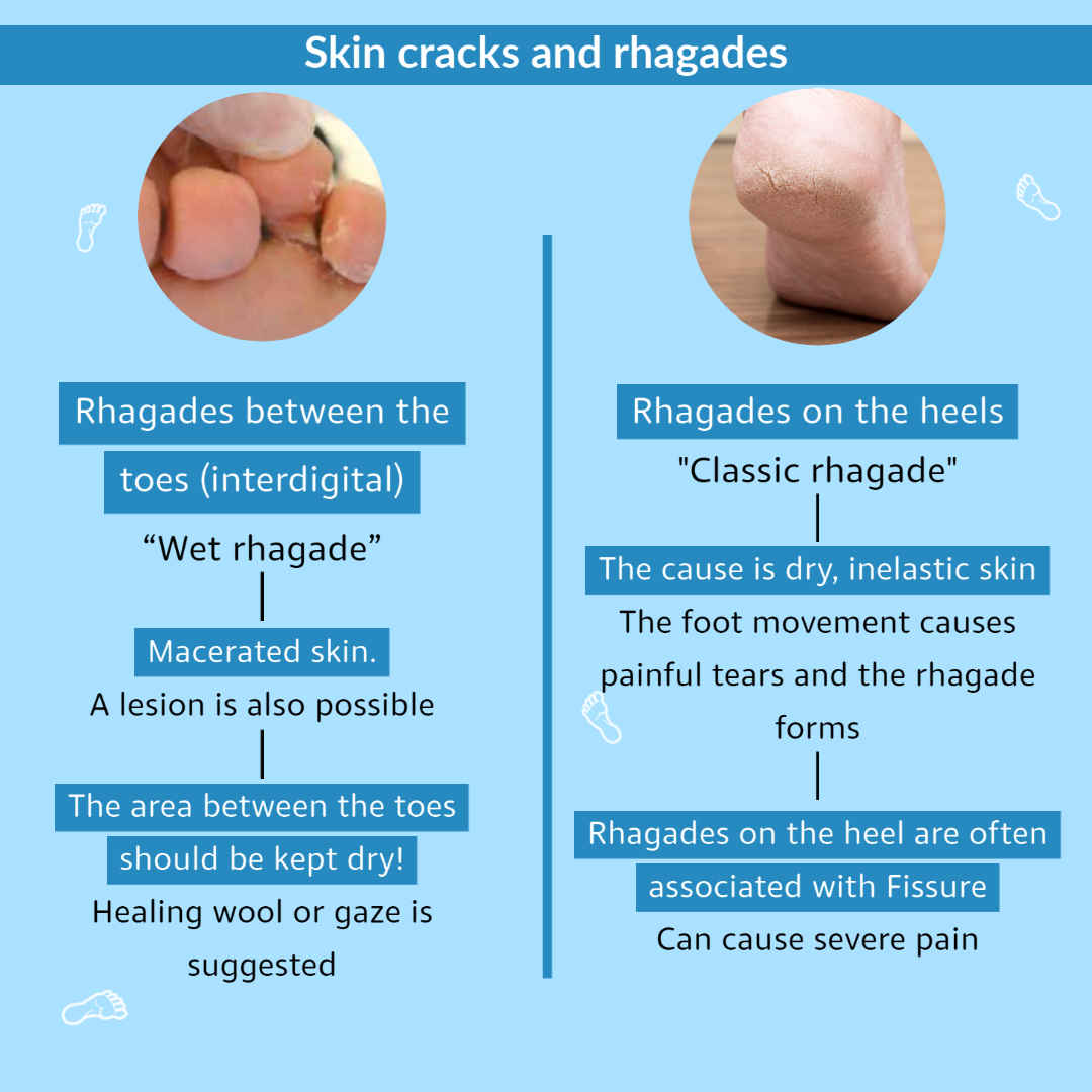 Waardig aflevering voeden GEHWOL Foot Care on Twitter: "Wet rhagades occur between the toes and  usually macerate. A lesion is also possible. The area between the toes  should be kept dry, 'healing wool' or gaze