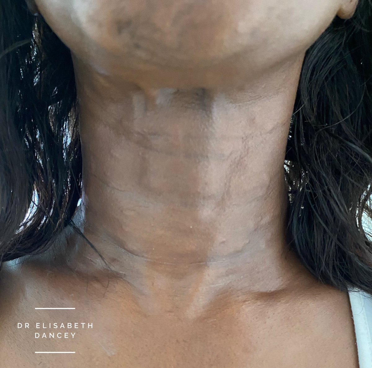 To rejuvenate the neck a great option are fillers but #botox can help too. Tiny injections are placed along the jawline and neck bands. The downward pull is reduced and a smoother more contoured and define neck and jaw is guaranteed #nefertitilift #botoxinjections #neckrejuvenate