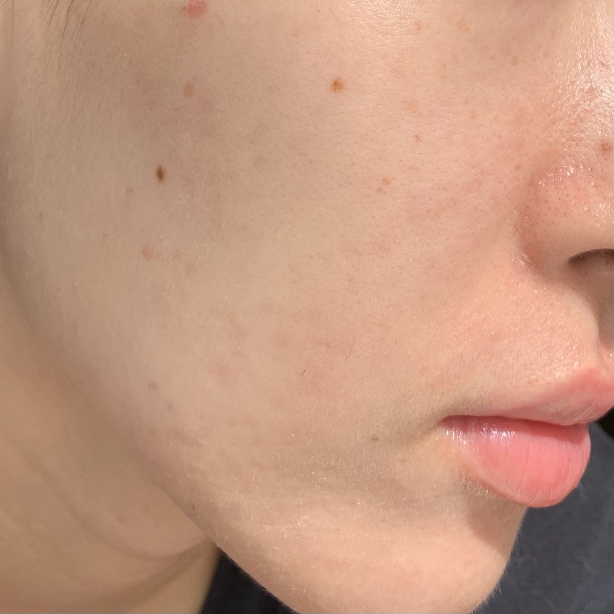 Hashtag ニキビ Sur Twitter