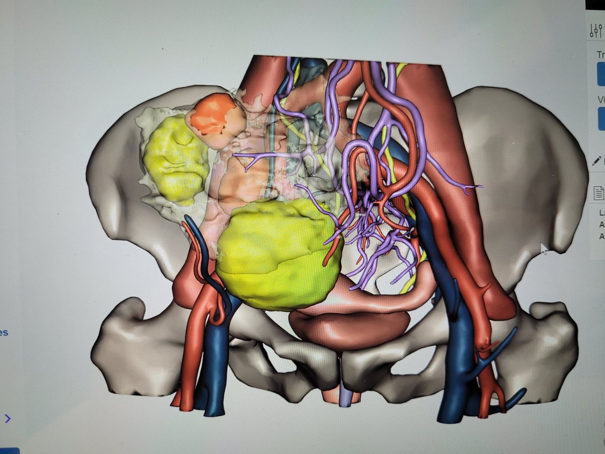 Montiel JimĂ©nez, MD., PhD., FEBS EmSurg, FEBS HPB (@montieljf) on Twitter photo Planning our abdominal sarcoma surgeries with 3D higiene quality reconstrucciones in <a href="/Hospital_FJD/">FundaciĂłn JimĂ©nez DĂaz</a> 🏨. A ver useful tool <a href="/VillarejoCampos/">pedro villarejo campos</a> <a href="/GarciaOlmoD/">Damian Garcia-Olmo, Professor of Surgery</a> <a href="/GrupoGeis/">GEIS</a> #OperaElSarcoma #cellams <a href="/aecirujanos/">aecirujanos</a> <a href="/h_guadalajara/">Hector Guadalajara</a> #GrupoSarcomaFJD <a href="/CellaMedical3D/">Cella Medical Solutions</a> <a href="/MicrosoftES/">Microsoft España</a> Planning our abdominal sarcoma surgeries with 3D higiene quality reconstrucciones in <a href="/Hospital_FJD/">FundaciĂłn JimĂ©nez DĂaz</a> 🏨. A ver useful tool <a href="/VillarejoCampos/">pedro villarejo campos</a> <a href="/GarciaOlmoD/">Damian Garcia-Olmo, Professor of Surgery</a> <a href="/GrupoGeis/">GEIS</a> #OperaElSarcoma #cellams <a href="/aecirujanos/">aecirujanos</a> <a href="/h_guadalajara/">Hector Guadalajara</a> #GrupoSarcomaFJD <a href="/CellaMedical3D/">Cella Medical Solutions</a> <a href="/MicrosoftES/">Microsoft España</a>