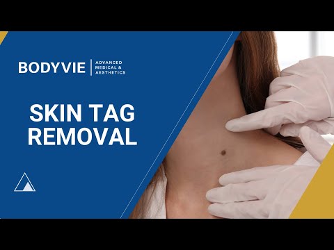 Skin Tag Removal with PlexR at Bodyvie in Richmond