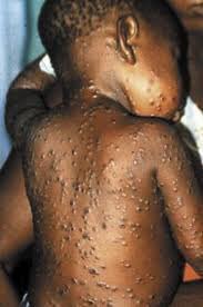 BREAKING NEWS: The Nigeria Centre for Disease Control (NCDC) says there has been an outbreak of MonkeyPox.

There are 59 suspected cases,
15 cases already confirmed.

In the next set of tweets;
I will tell you all you need to know on monkeypox.

It takes only 2seconds to Retweet.
