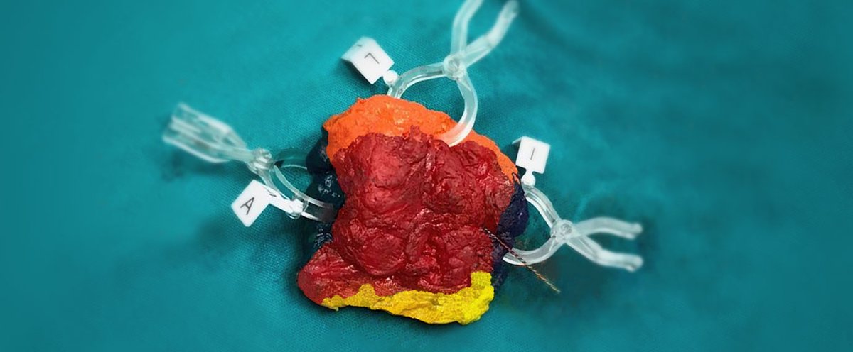 VectorSurgical's tweet image. The @UMNSurgOnc study found that “intraoperative inked specimens using MarginMarker provide a more accurate 3-dimensional location of the true positive margin.” #positivemargin @AltmanAriella @JHuiMD doi.org/10.1111/tbj.13…