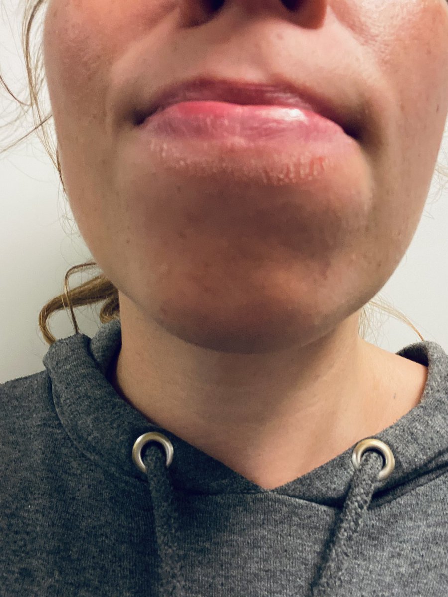 Ég, 28 ára, er með risa þurrkusár fyrir neðan varirnar því ég vanda mig svo mikið að mála að ég er með tunguna út á meðan 🤦🏻‍♀️